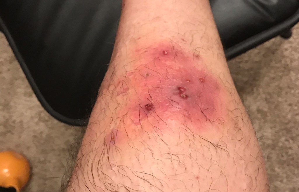 Wounded Me