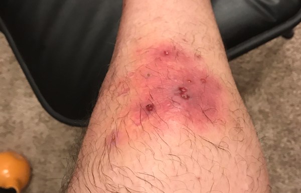 spider bite?